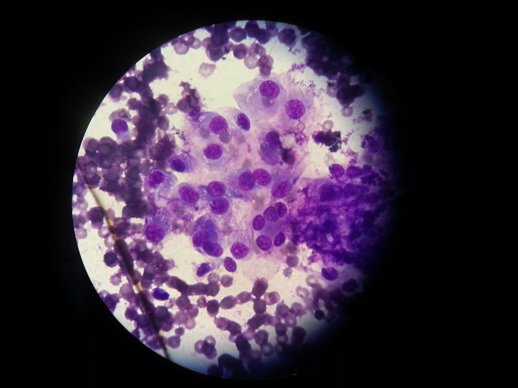 hemangiopericitoma1