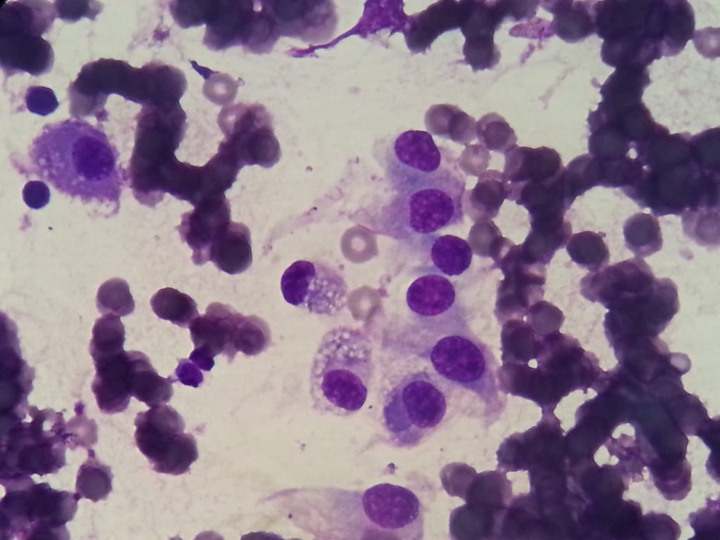 hemangiopericitoma3